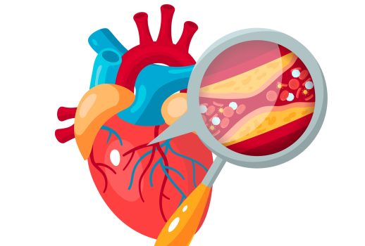 Atherosclerosis concept. Human heart and zoomed artery with plaque. Medical vector illustration in flat style