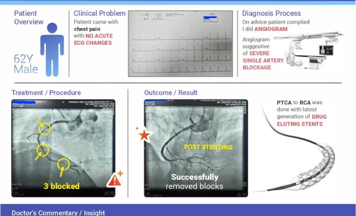 Heart attack but normal ecg a case of unstable angina